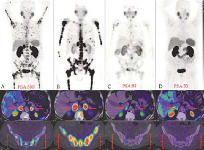 Le PET-CT PSMA dans le cancer prostatique
