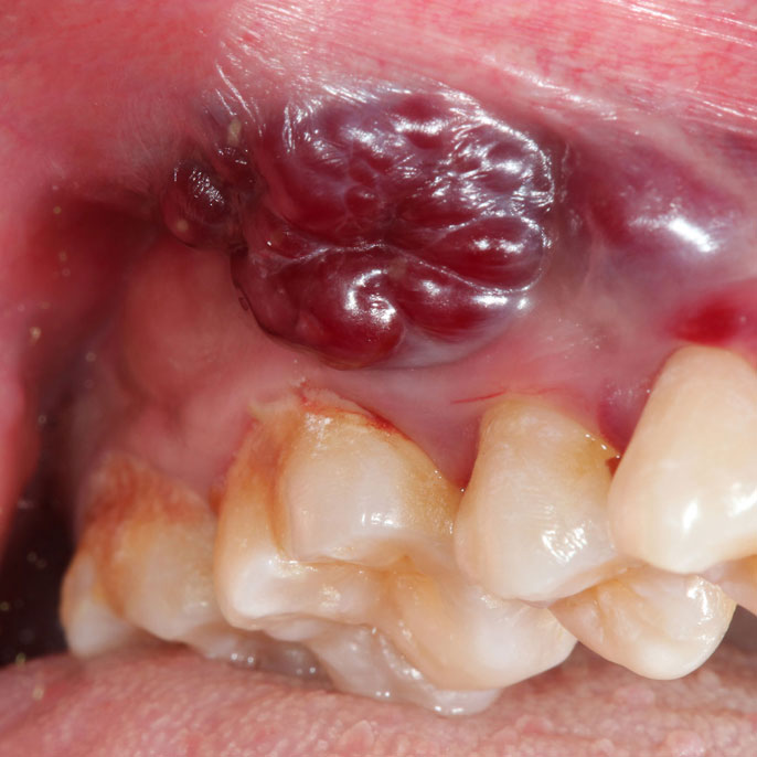 Ce n'est pas qu'un aphte...